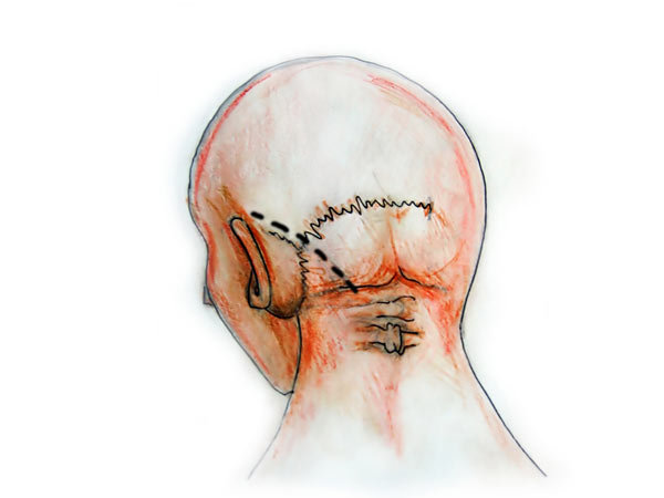 Old Reverse Question Mark Incision Retrosigmoid approach - 3D Atlas of Neurological Surgery